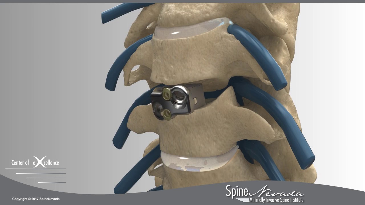 genesys-spine-cong-bo-cervical-doc-lap-khong-can-vit-duoc-in-3d-dau-tien